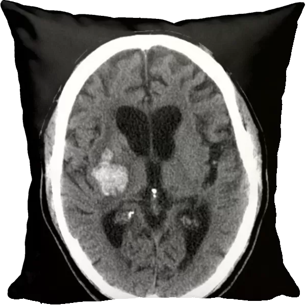 Subarachnoid haemorrhage, MRI scan