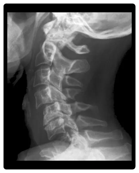 Dislocated neck bones, X-ray
