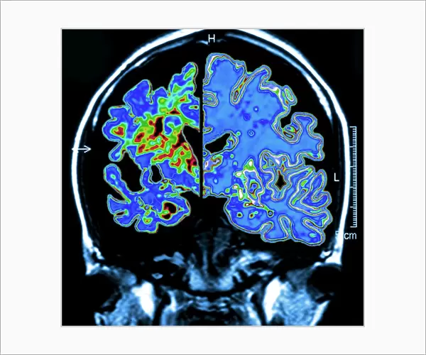 Alzheimers brain, computer artwork