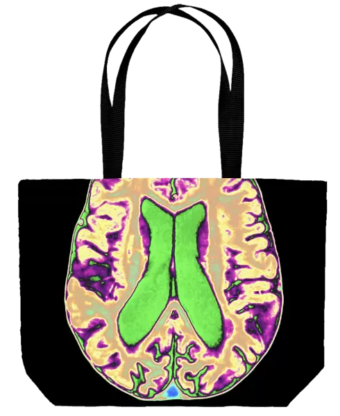 Coloured MRI scan of organophosphate brain damage