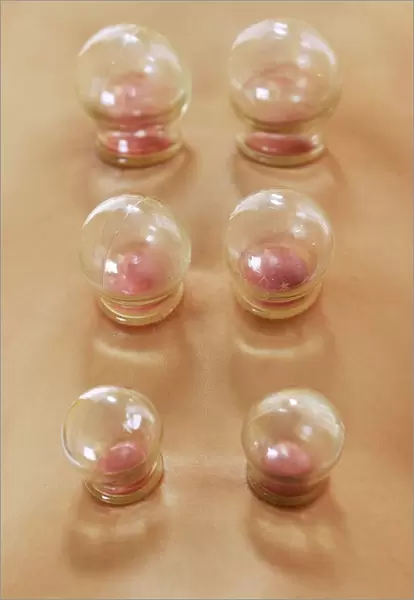Cupping. MODEL RELEASED. Cupping. Cupping, or fire cupping, is a practice derived
