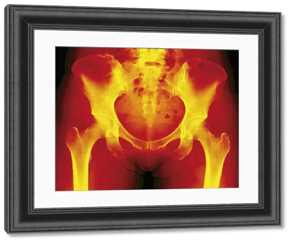Normal female pelvis, X-ray