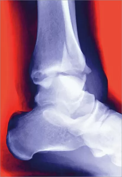 Fractured ankle, X-ray