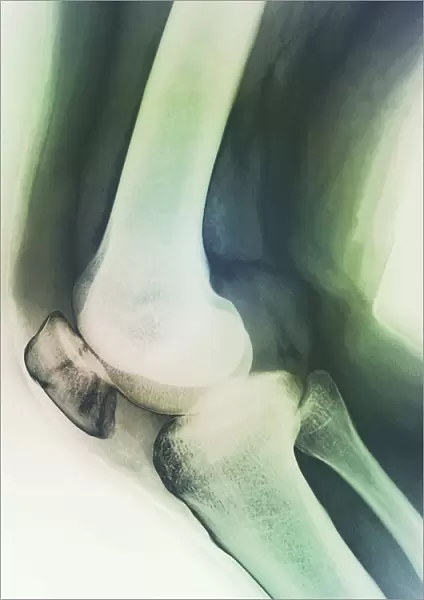 Broken knee, X-ray