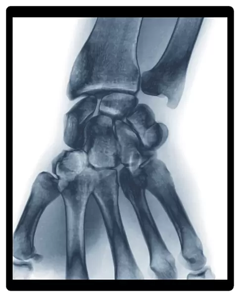 Normal wrist, X-ray