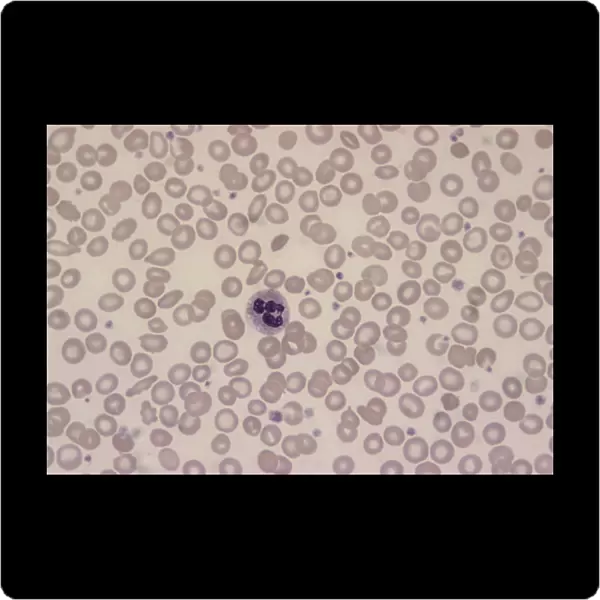LM of blood smear showing iron-deficiency anaemia