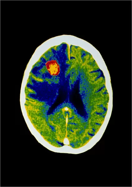 Coloured CT scan of brain abscess in AIDS patient