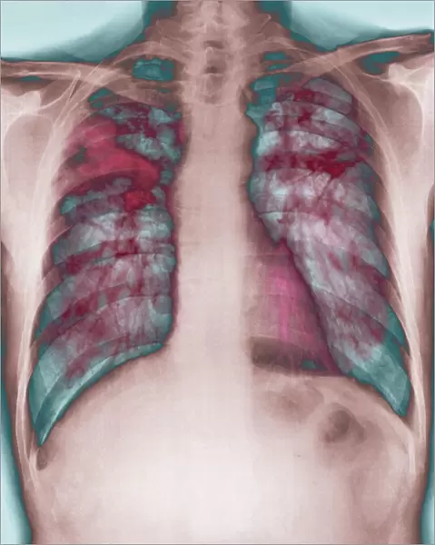 Fibrosis of the lung, X-ray
