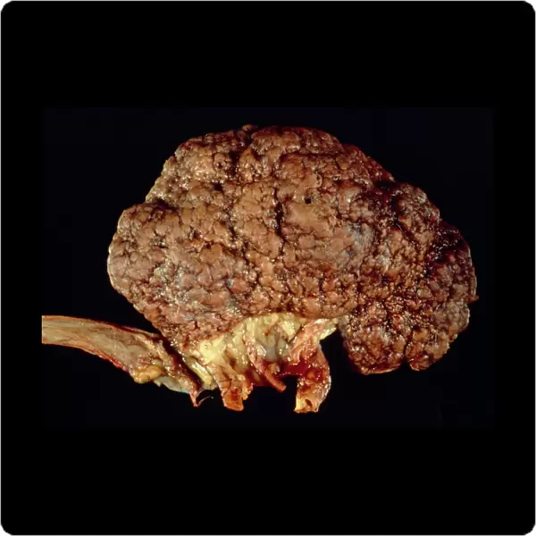 Gross specimen of kidney scarred by hypertension