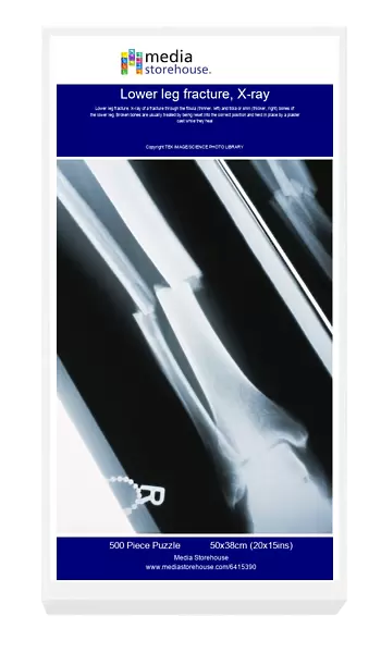 Lower leg fracture, X-ray