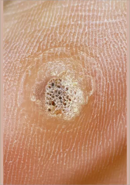Verruca. A verruca (or plantar wart), a small benign growth in the skin