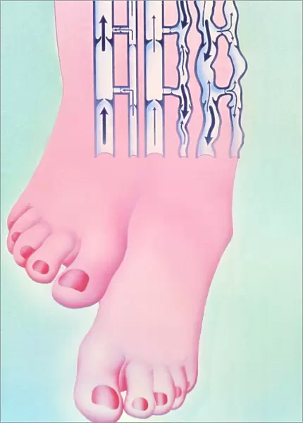 Artwork of legs with healthy and varicose veins