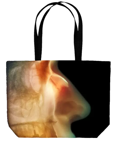Broken nose, X-ray