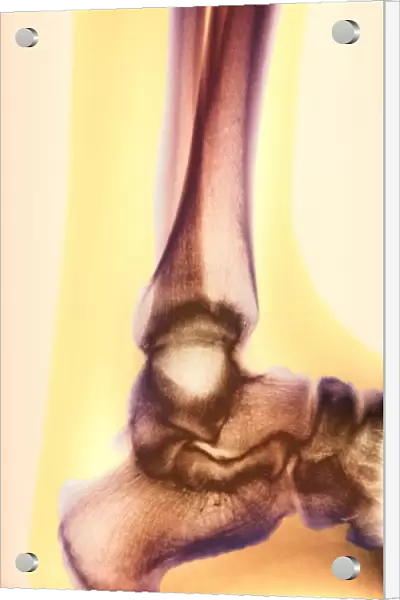 Healed leg break, X-ray