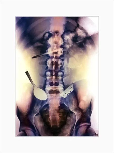Coloured X-ray of spoon and blade in intestine