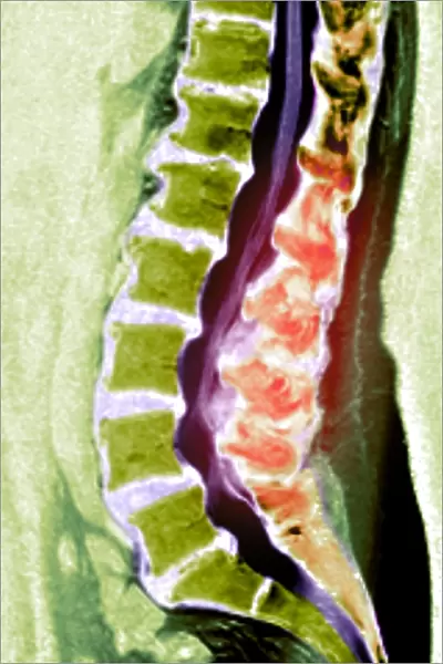 Spine degeneration, MRI scan