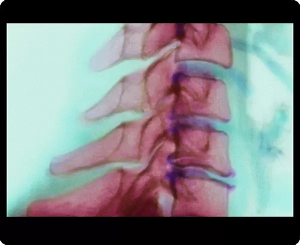 Bony spurs in neck, X-ray