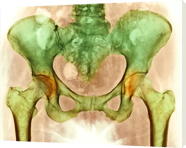 Osteoarthritis of hip joints, X-ray