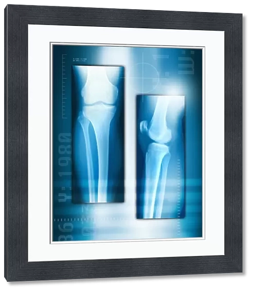 Knee joint from front and side, X-ray