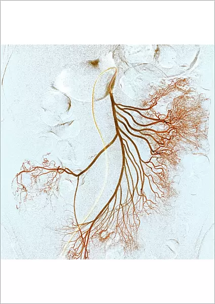 Abdominal blood vessels, X-ray