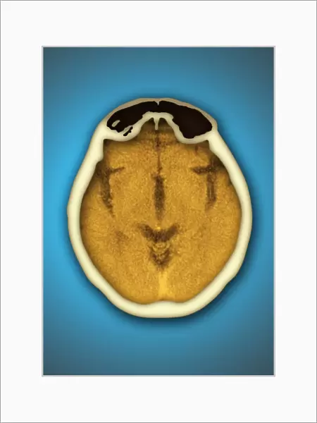 Healthy brain and frontal sinus, CT scan