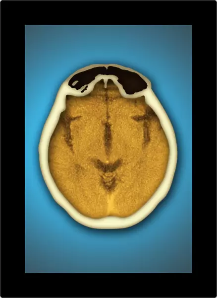 Healthy brain and frontal sinus, CT scan
