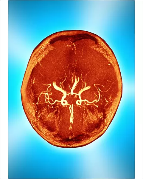 Brain and arteries, coloured CT scan