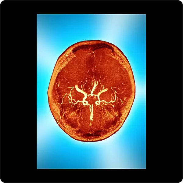 Brain and arteries, coloured CT scan