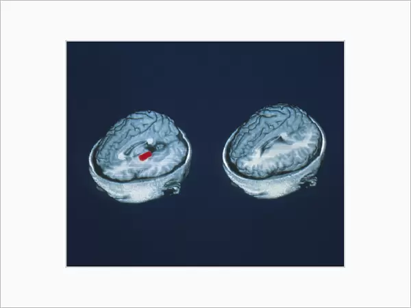 PET brain scans showing mistaken memory of words