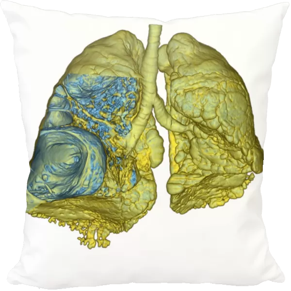 Emphysema of the lungs, CT scan