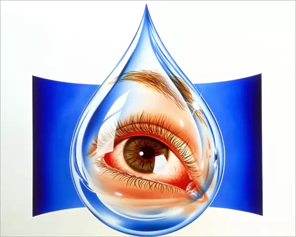 Artwork of an eye with conjunctivitis in tear drop