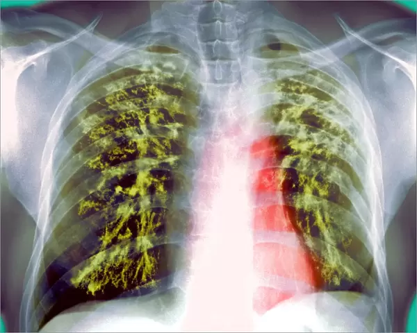 Lung scarring from tuberculosis, X-ray