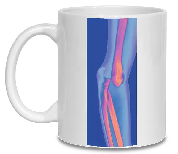 Dislocated elbow joint, X-ray