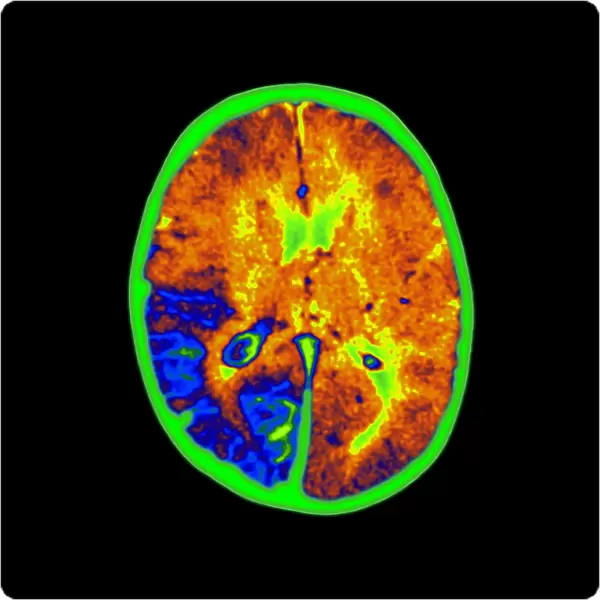 Coloured MRI brain scan of Sturge-Weber syndrome