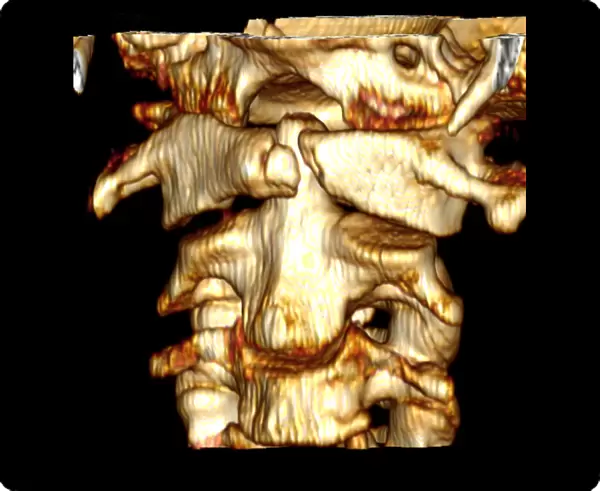 Fractured atlas vertebra, 3D CT scan
