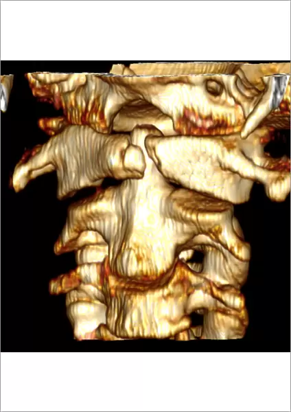 Fractured atlas vertebra, 3D CT scan