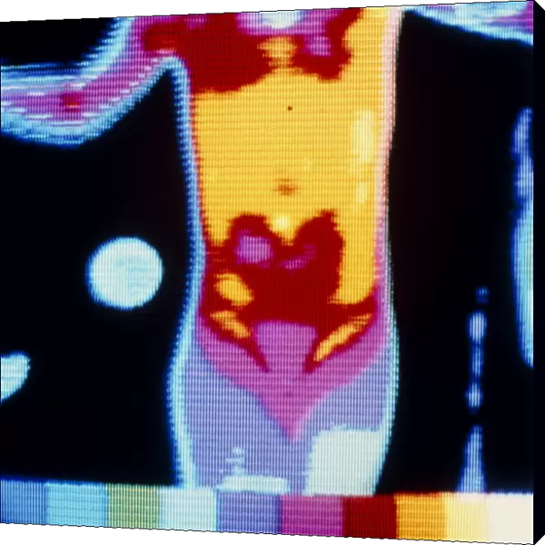 Thermogram of young infant suffering from burns