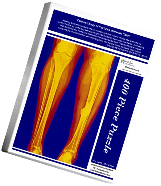 Coloured X-ray of fractured shin bone (tibia)