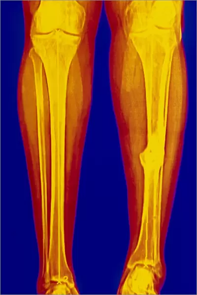 Coloured X-ray of fractured shin bone (tibia)