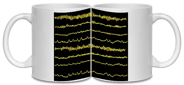 Normal EEG read out of the brains alpha waves