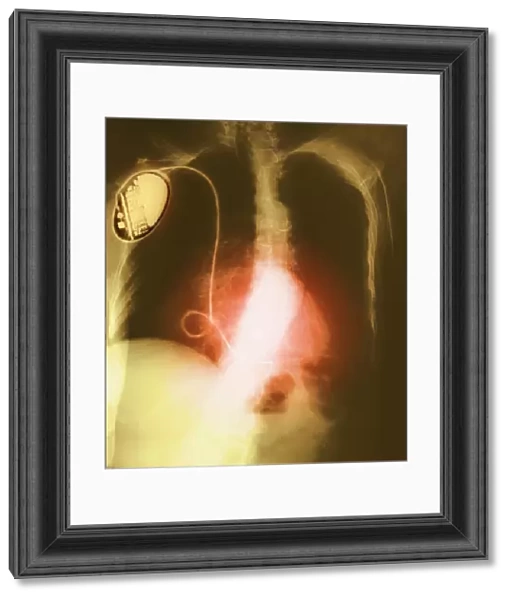 Coloured chest X-ray showing heart pacemaker