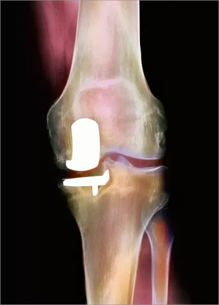 Knee joint prosthesis, X-ray
