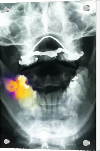 Coloured X-ray of impacted wisdom tooth and brace