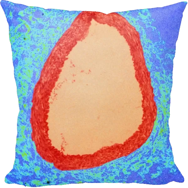 Coloured LM of a section through a coronary artery