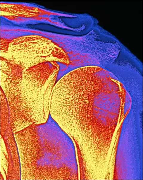 Shoulder joint X-ray