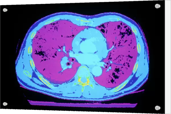 False-colour CT scan of normal heart & lungs