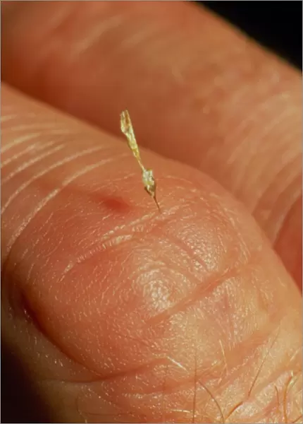Sting of a honeybee embedded in a human finger