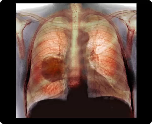 Lung cancer, X-ray C016  /  4433