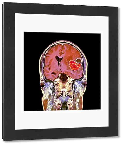 Brain cancer, MRI scan C016  /  4438