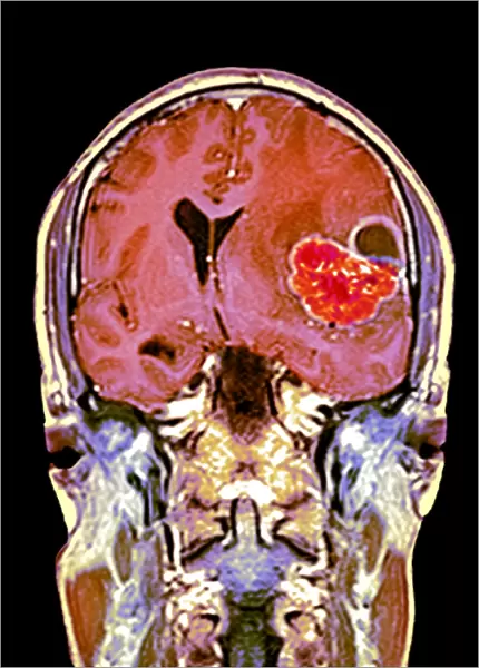 Brain cancer, MRI scan C016  /  4438